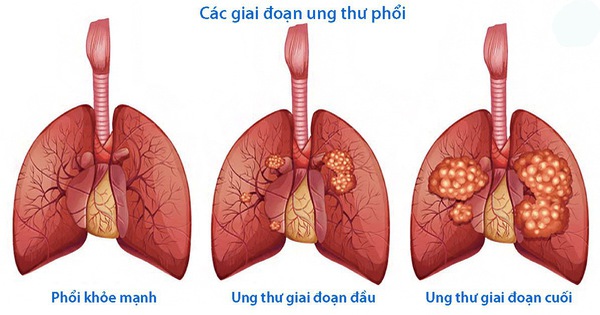 Các giai đoạn phát triển của bệnh ung thư phổi