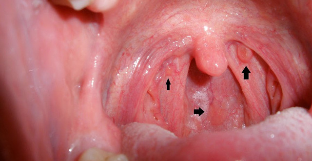 ung thư vòm họng giai đoạn 2