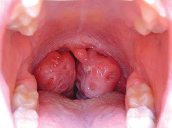 ung thư vòm họng giai đoạn 4