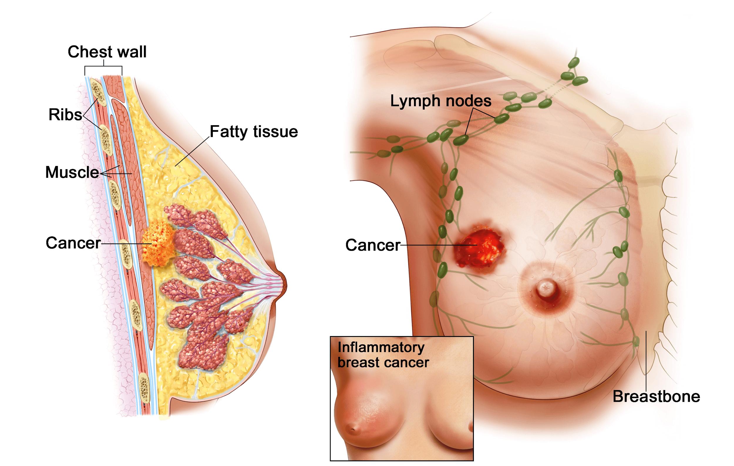 xét nghiệm dấu ấn ung thư tuyến vú