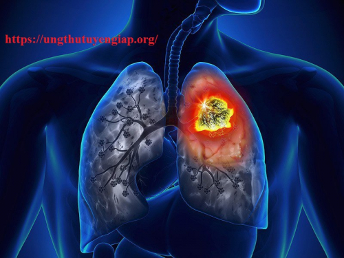 Những thông tin cơ bản về bệnh ung thư phổi