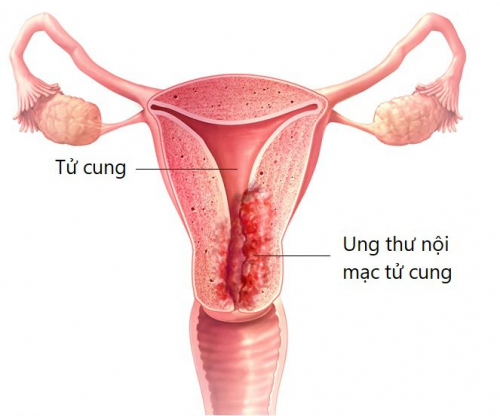 Điều trị và theo dõi Ung thư nội mạc tử cung