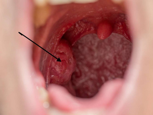 Cách phân biệt ung thư vòm họng và viêm họng