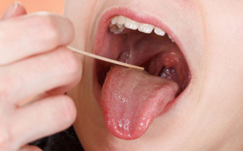 Ung thư vòm họng - nguyên nhân, dấu hiệu và cách điều trị bệnh